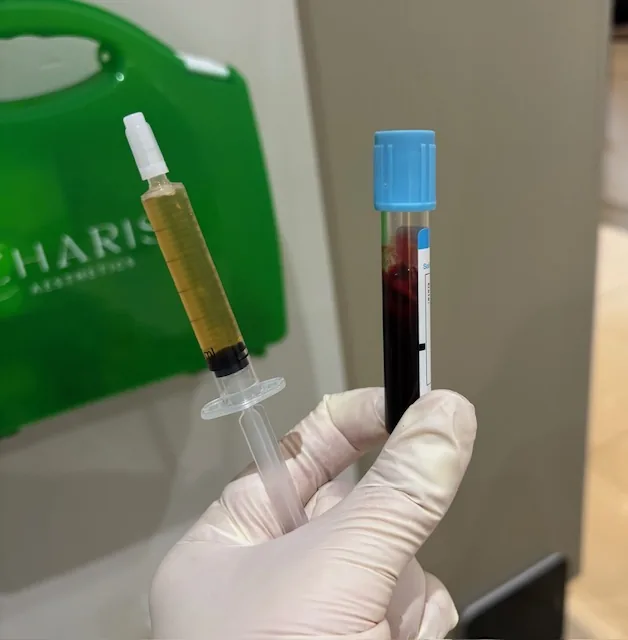 Platelet-rich plasma separated and drawn ready for treatment at Charis Aesthetics