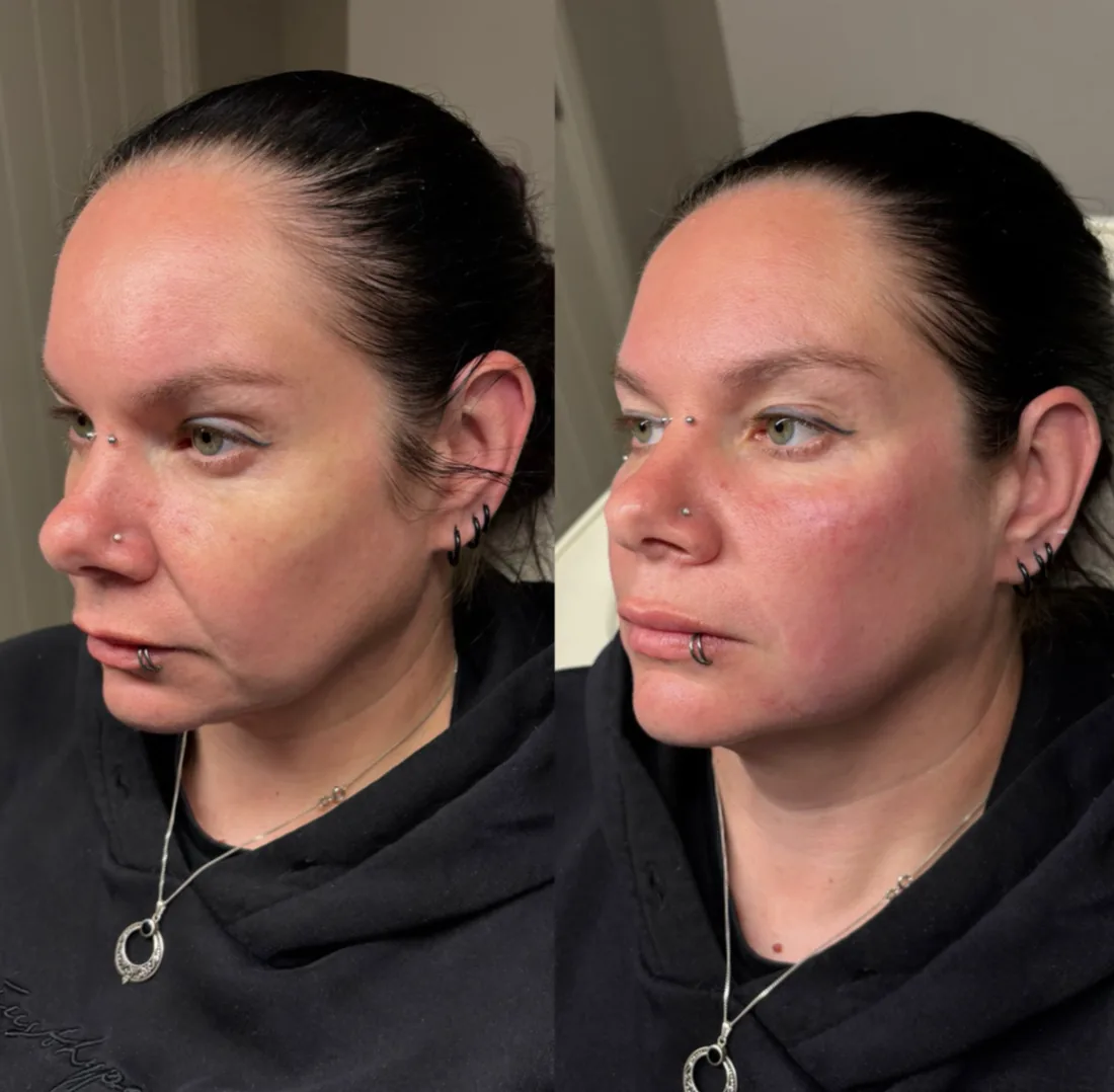 Facial harmonisation result showing restored support and balance