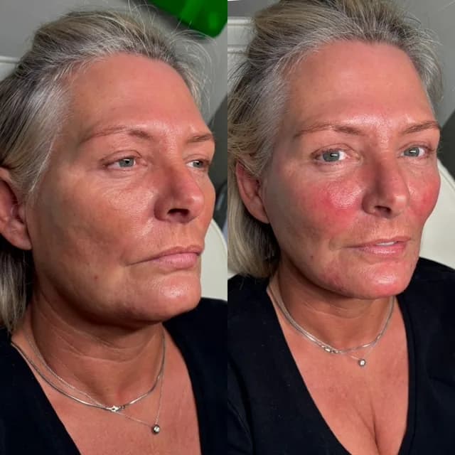 Facial harmonisation before and after — restored support in the midface