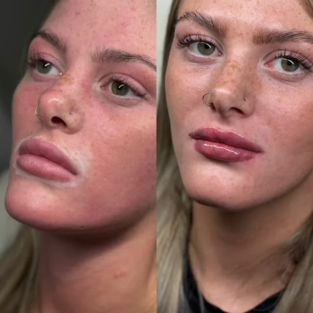 Lip enhancement before and after — shape and balance improved without added bulk