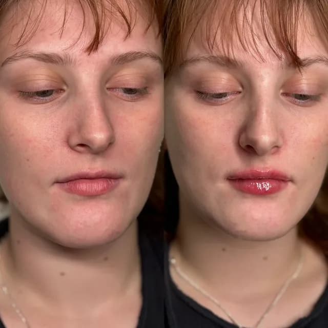 Lip filler dissolved and rebuilt to a softer shape