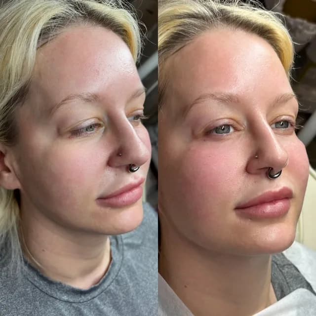 Non-surgical rhinoplasty before and after, shown at three-quarter angle