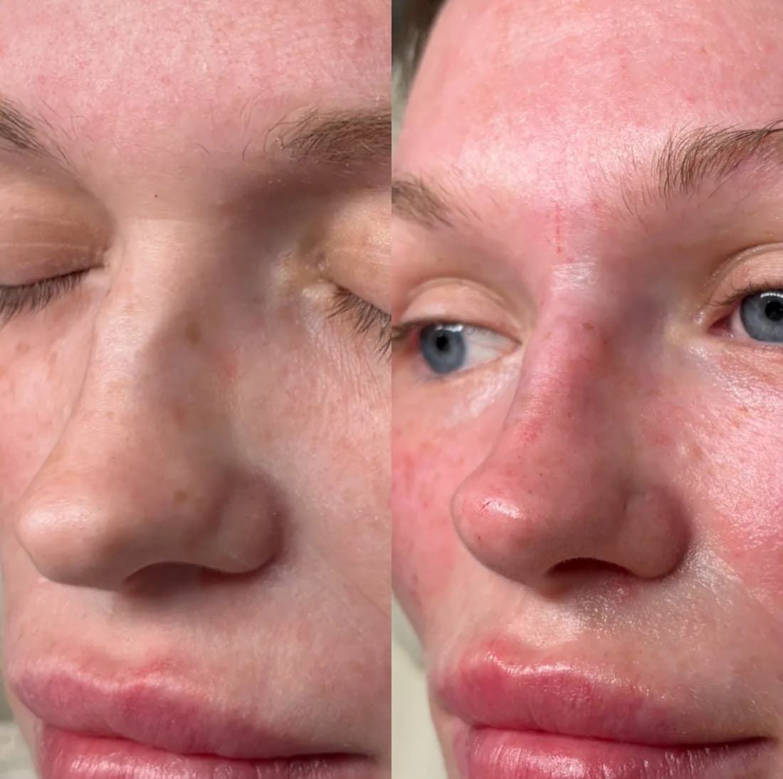 Non-surgical rhinoplasty before and after — dorsal hump camouflaged and tip supported