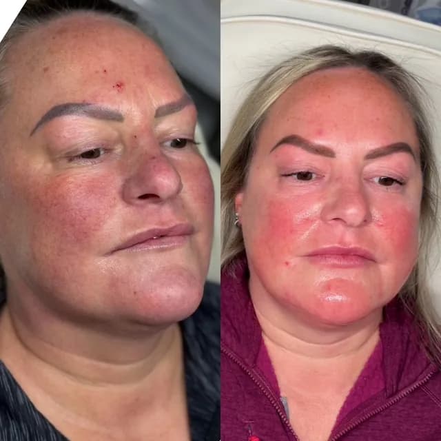 Skin treatment before and after — reduced redness and more even tone