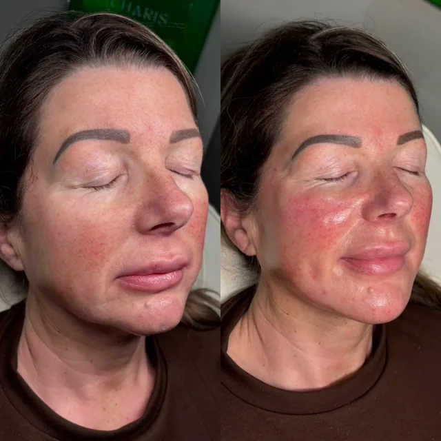 Skin treatment before and after — calmer, more even complexion
