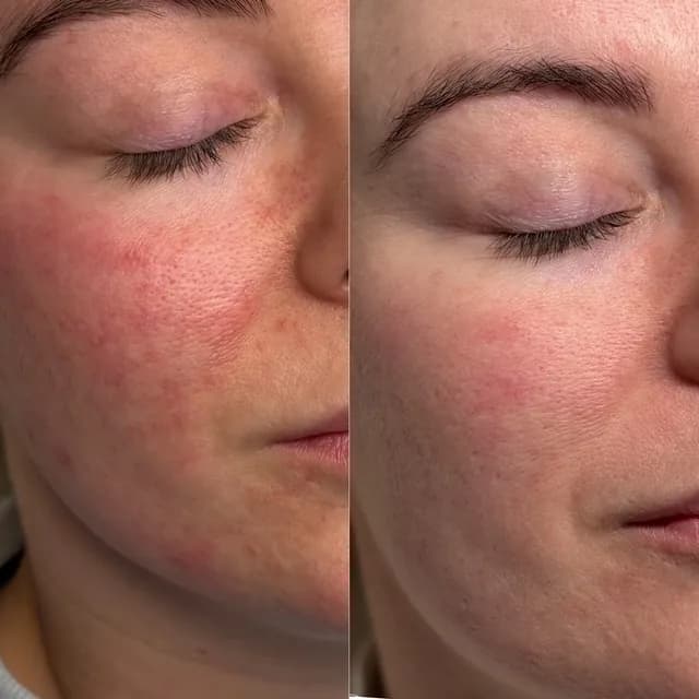Skin treatment before and after — smoother texture and improved tone