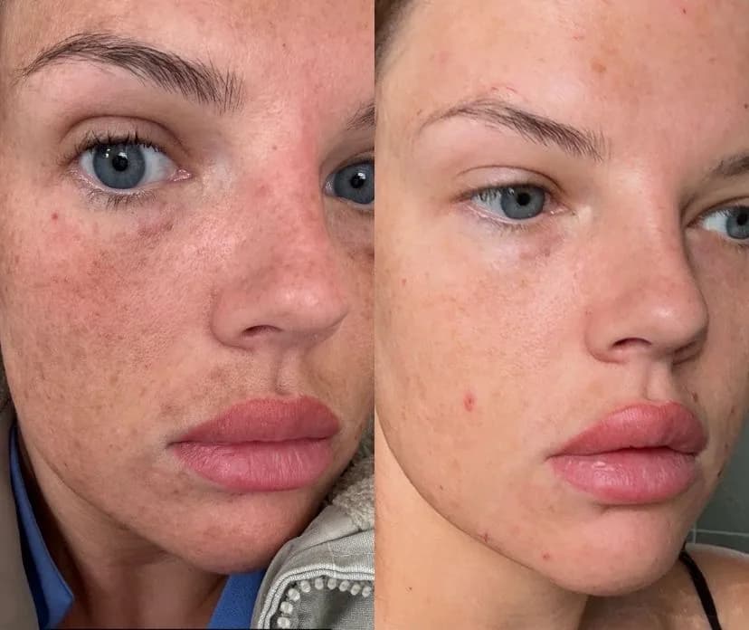 Skin treatment before and after — improved texture and clarity