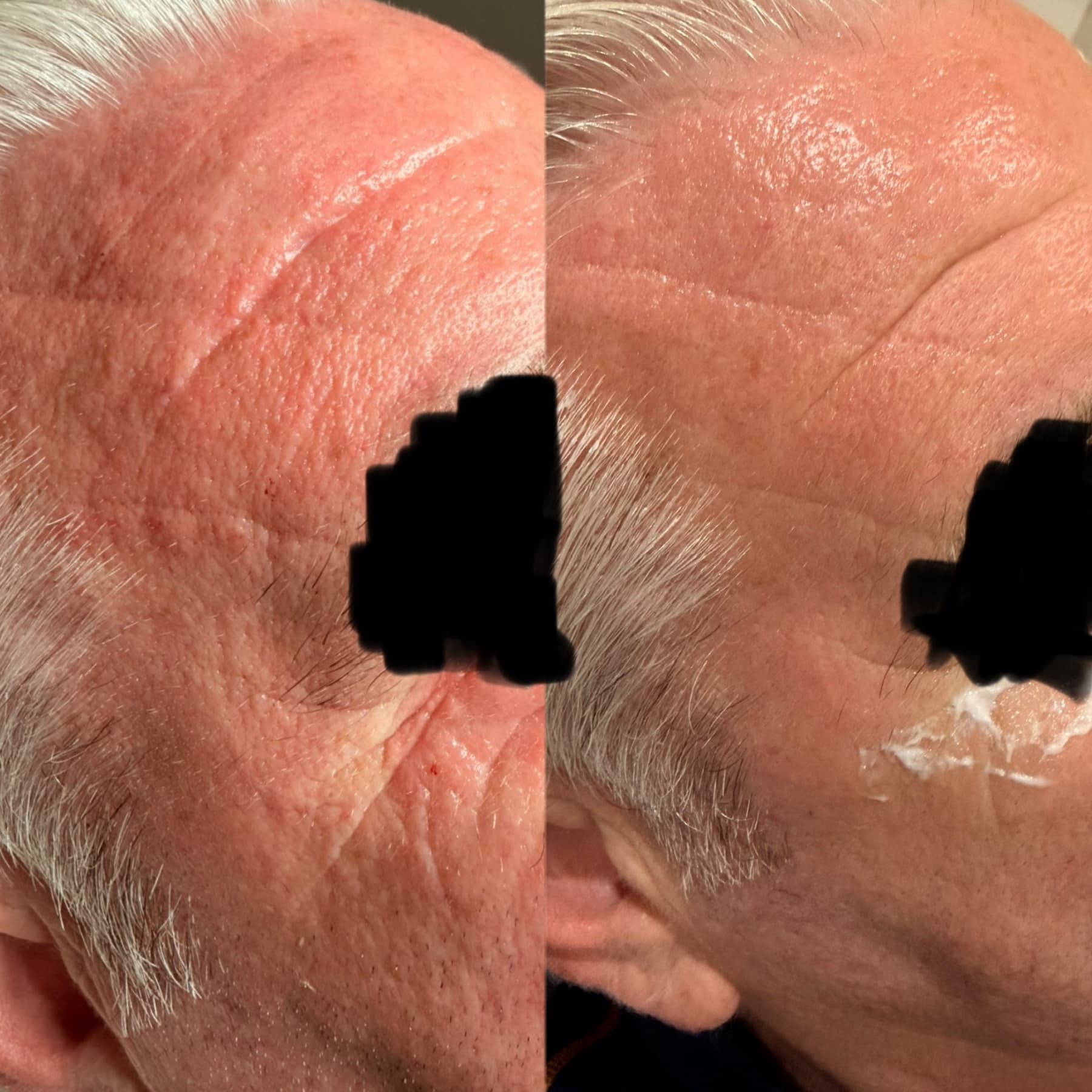 Polynucleotides before and after at Charis Aesthetics