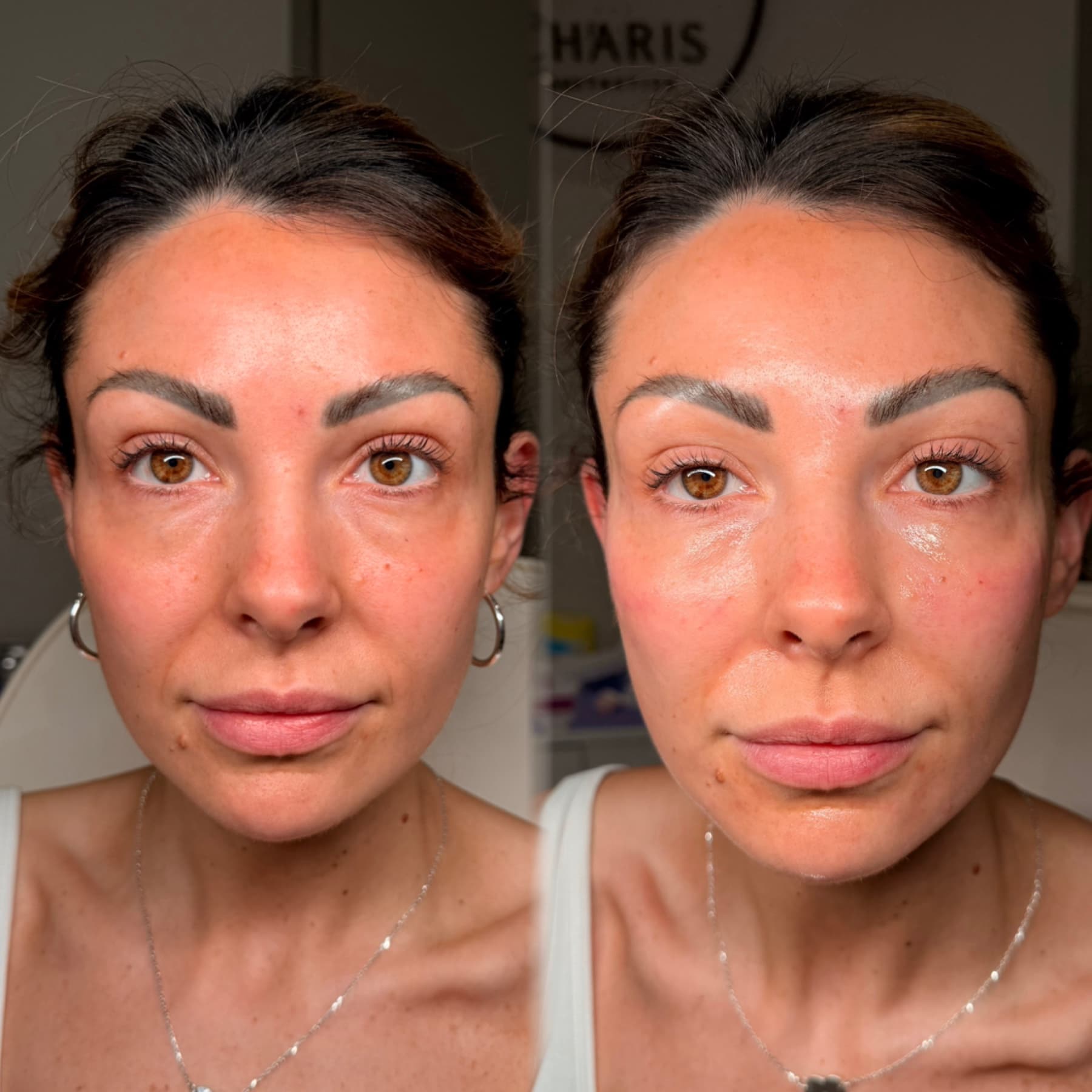 Cheek Filler before and after at Charis Aesthetics