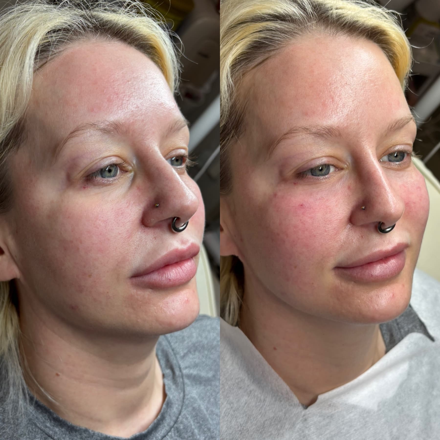 Tear Trough Treatment before and after at Charis Aesthetics