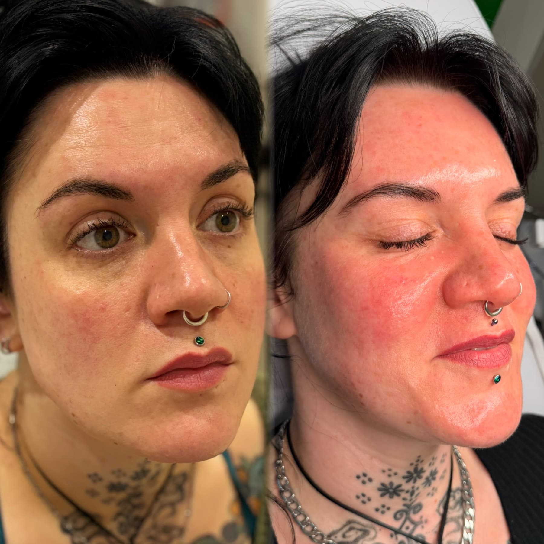 Skin Boosters before and after at Charis Aesthetics