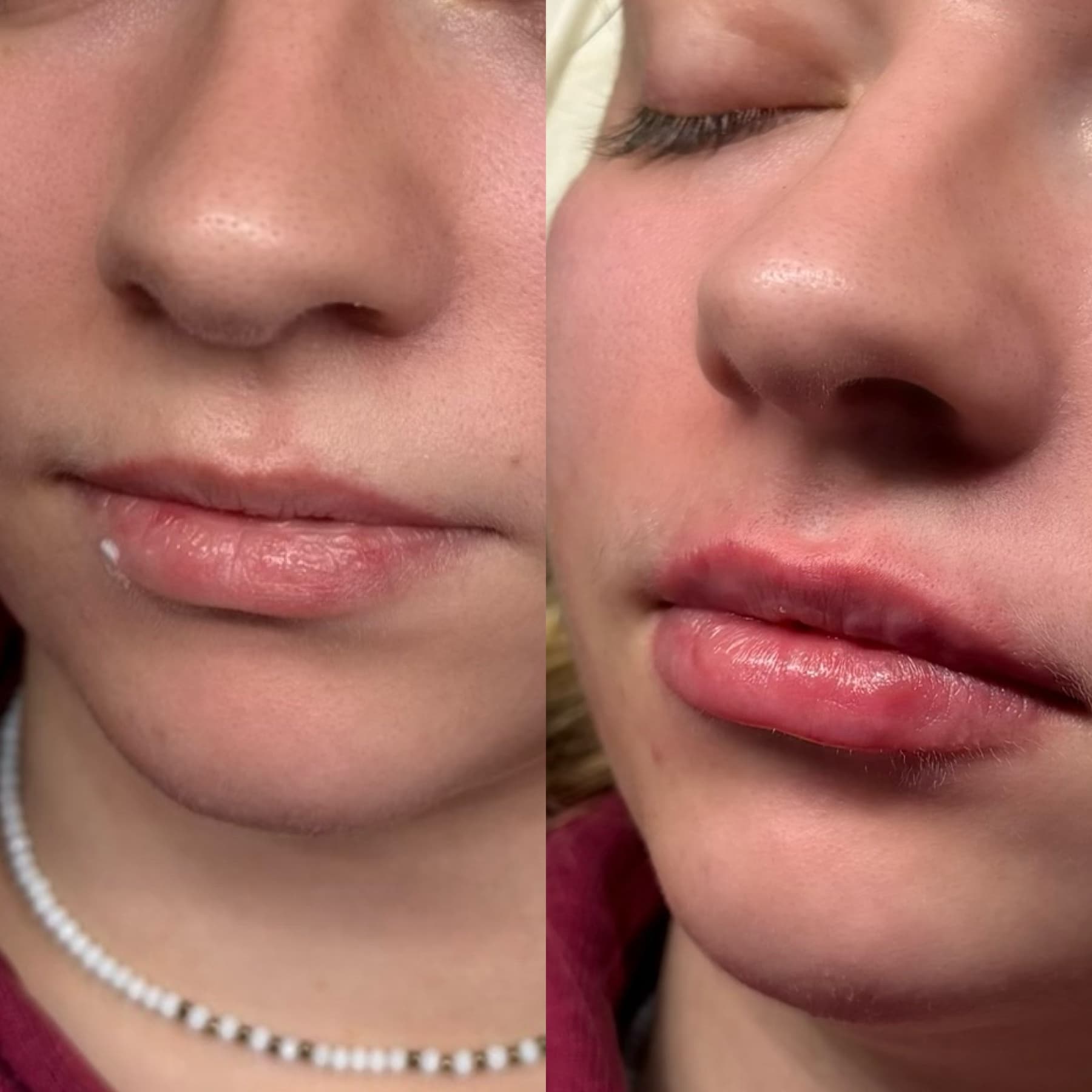 Signature Lips before and after at Charis Aesthetics