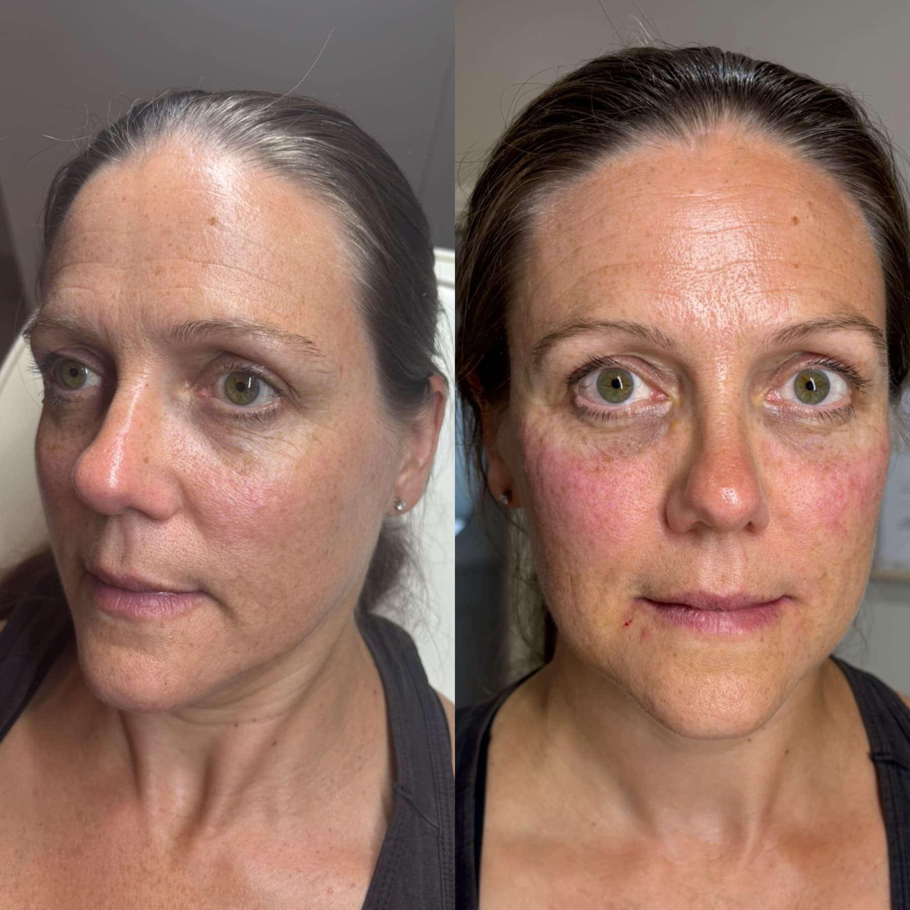Microneedling before and after at Charis Aesthetics