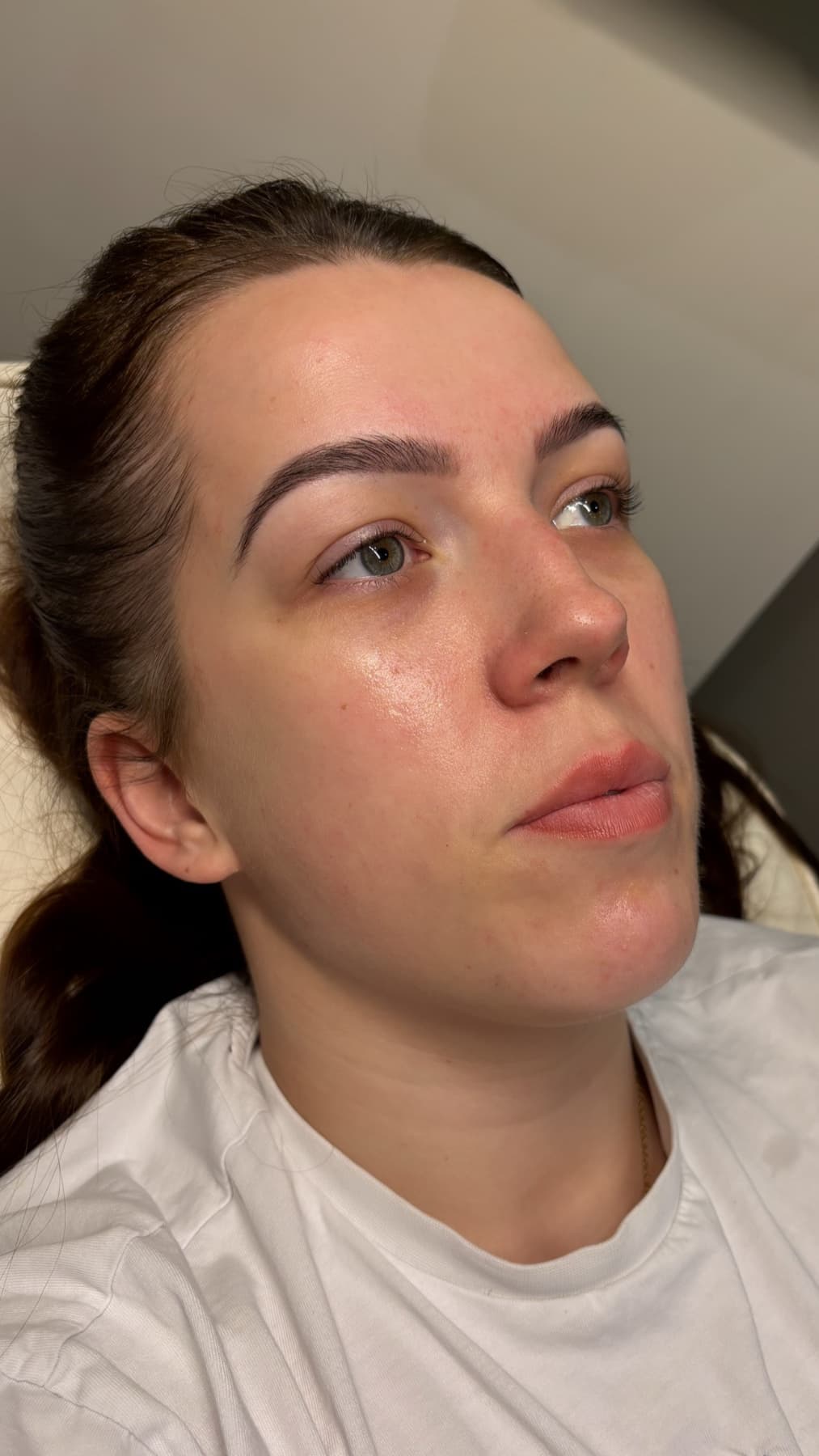 PRP & PRF Facial before and after at Charis Aesthetics