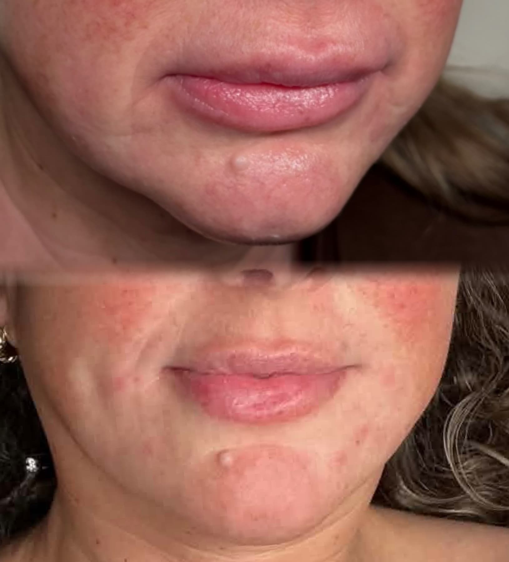 Chin Filler before and after at Charis Aesthetics