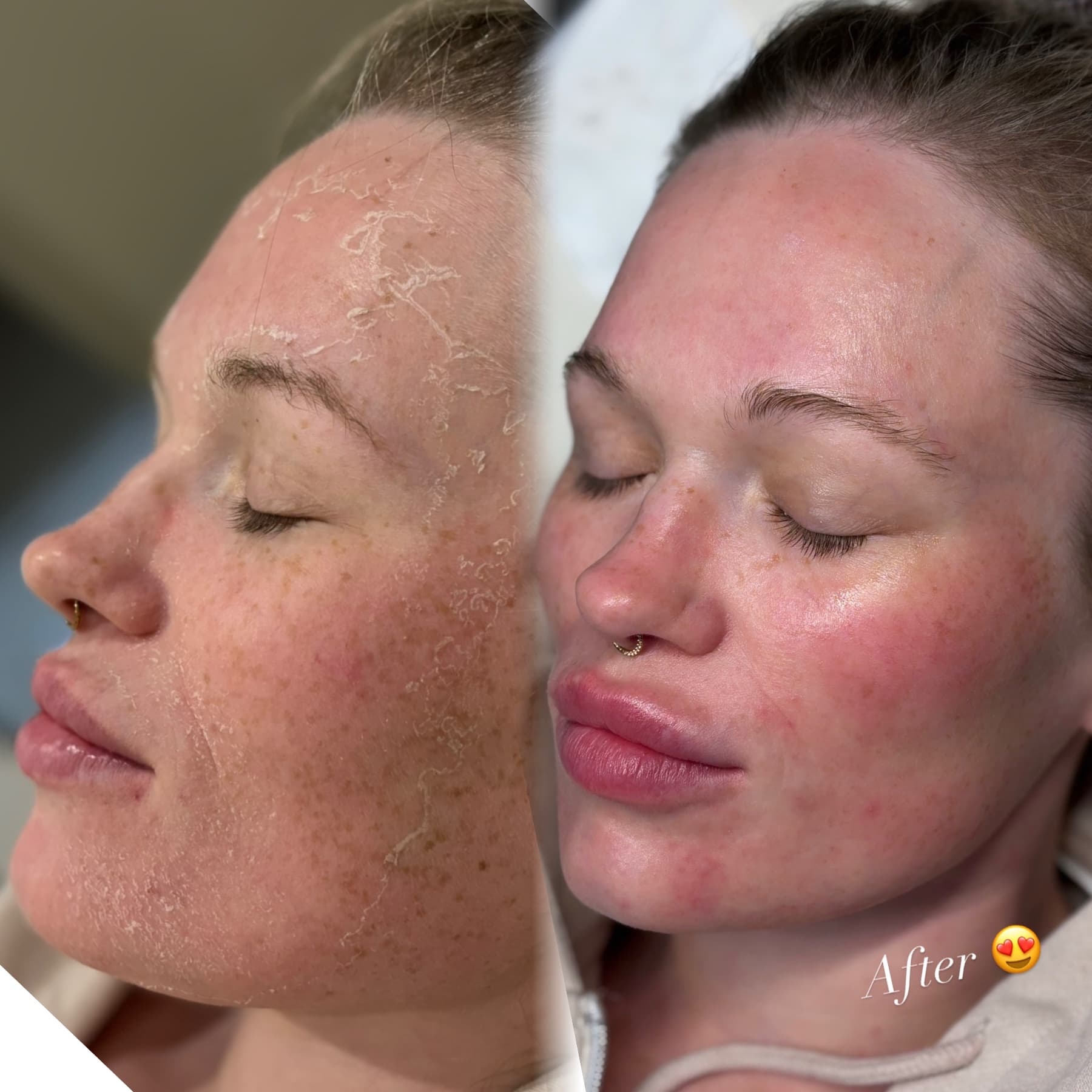 Bio-Spicule Therapy before and after at Charis Aesthetics