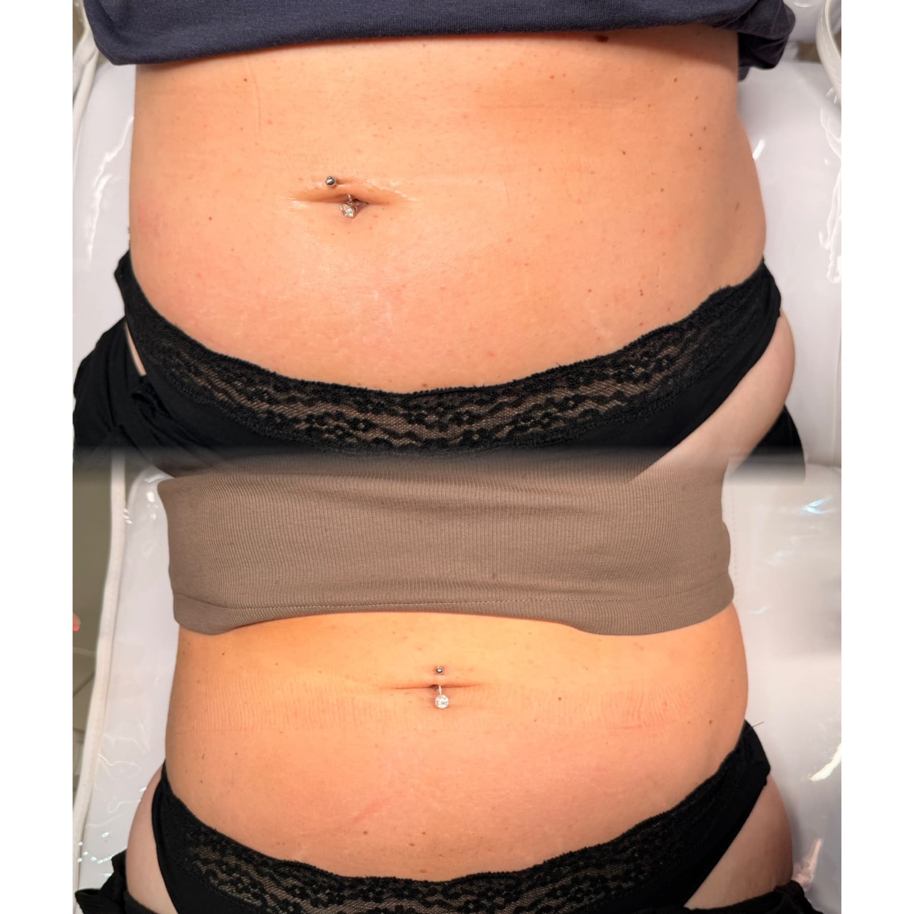Fat Dissolving Injections before and after at Charis Aesthetics