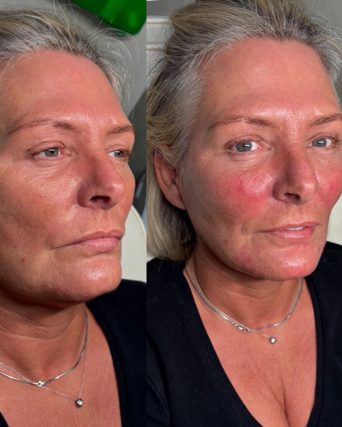 Facial Harmonisation before and after at Charis Aesthetics