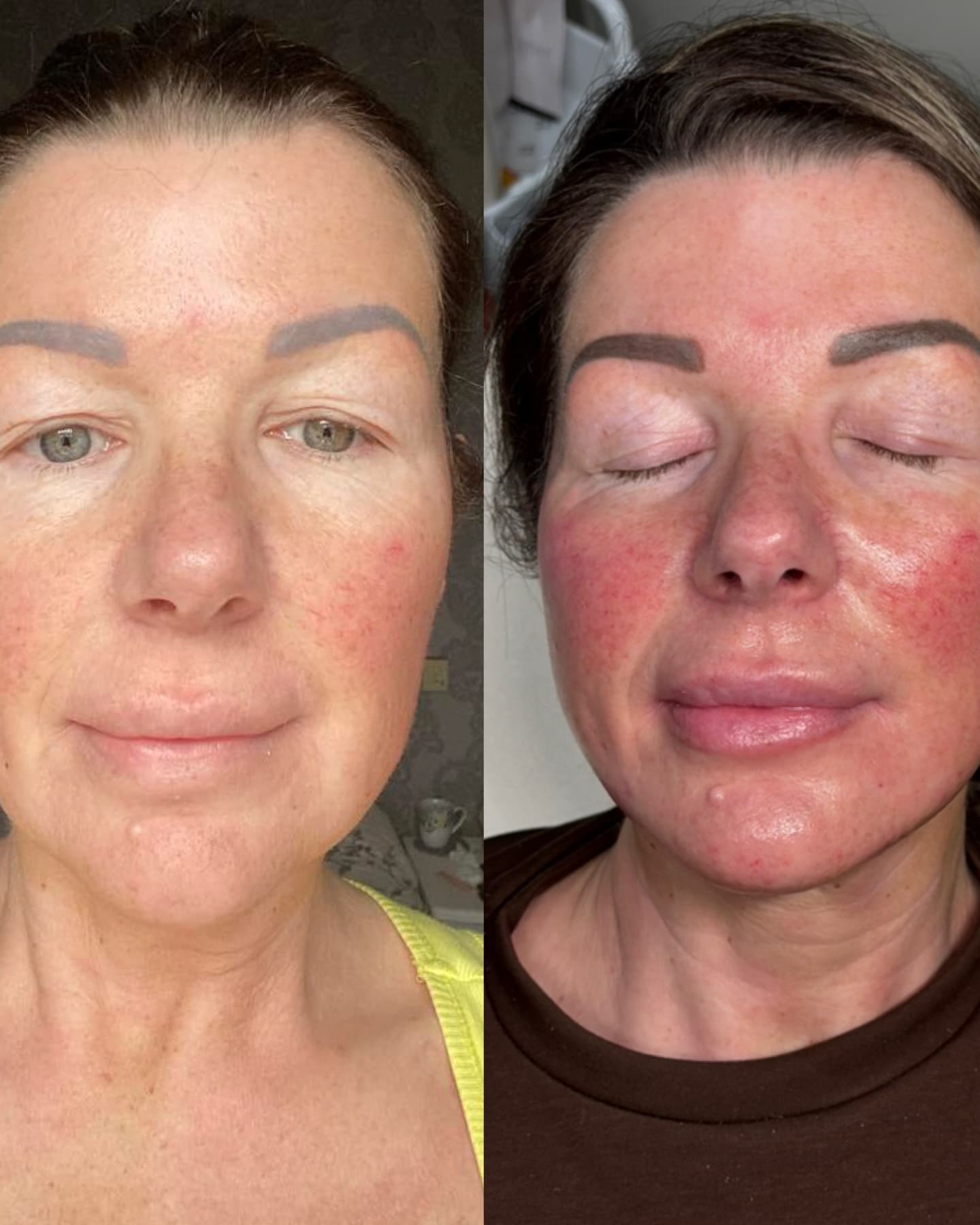 Facial Harmonisation before and after at Charis Aesthetics