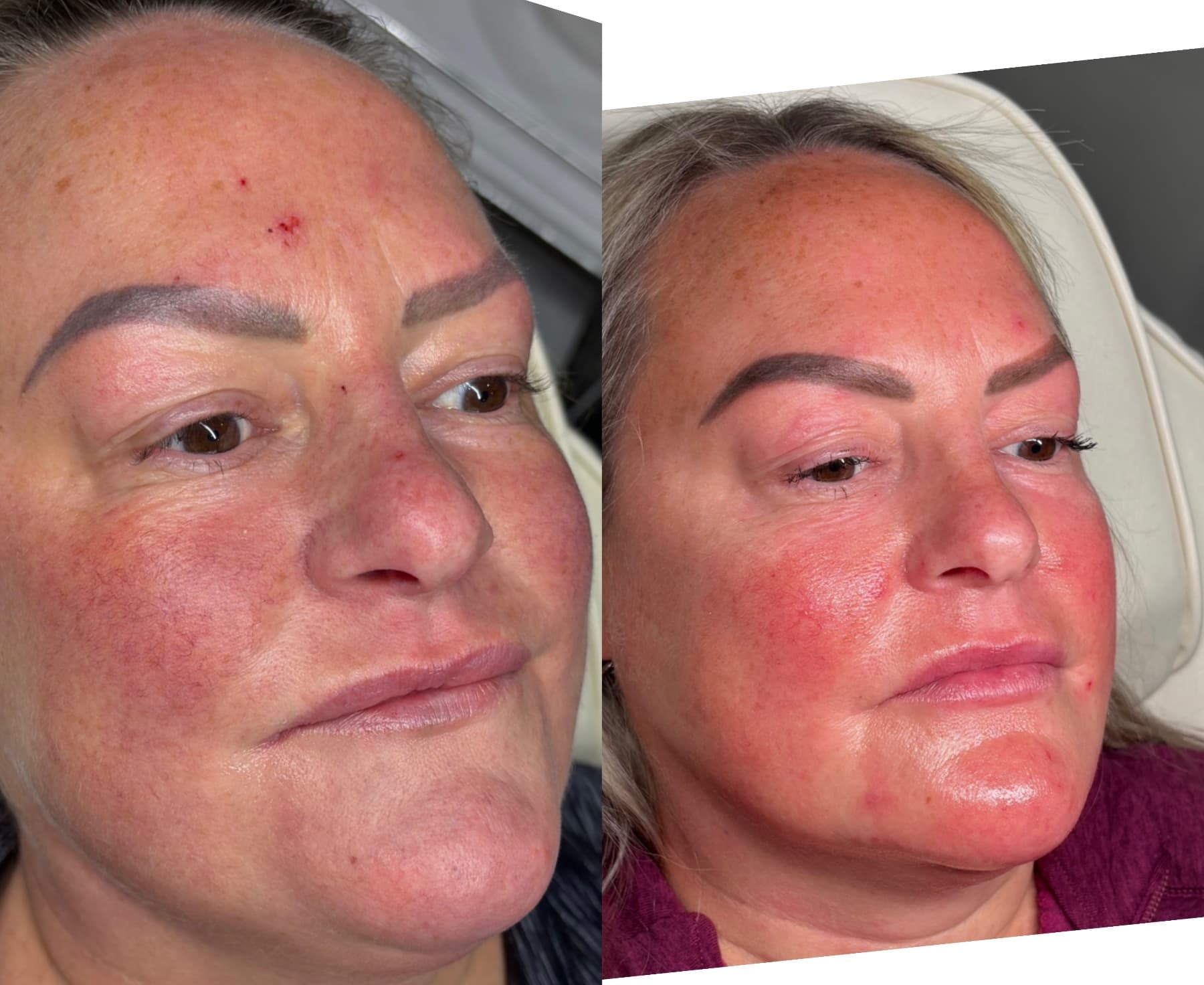 Jawline Filler before and after at Charis Aesthetics
