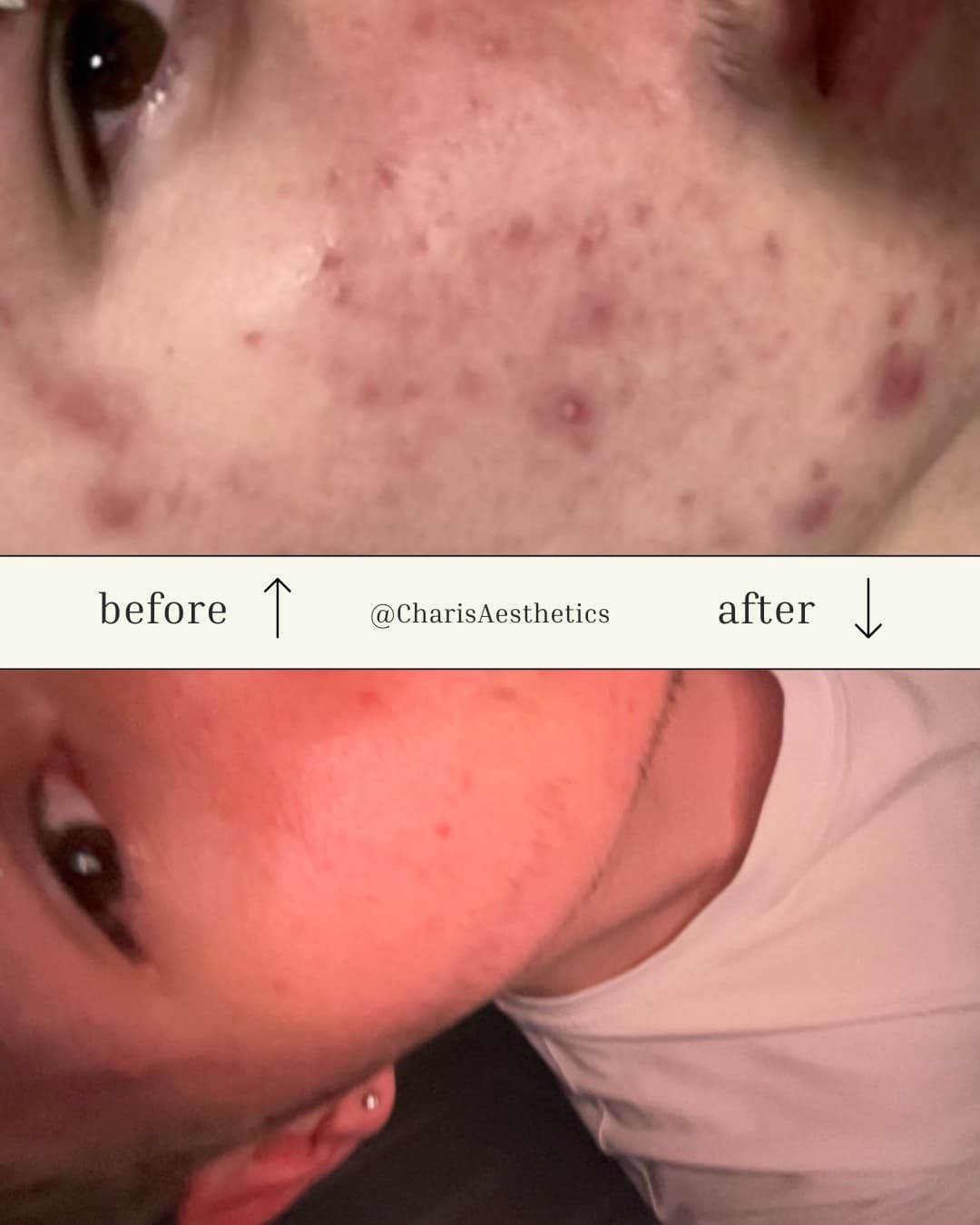 Chemical Peels before and after at Charis Aesthetics