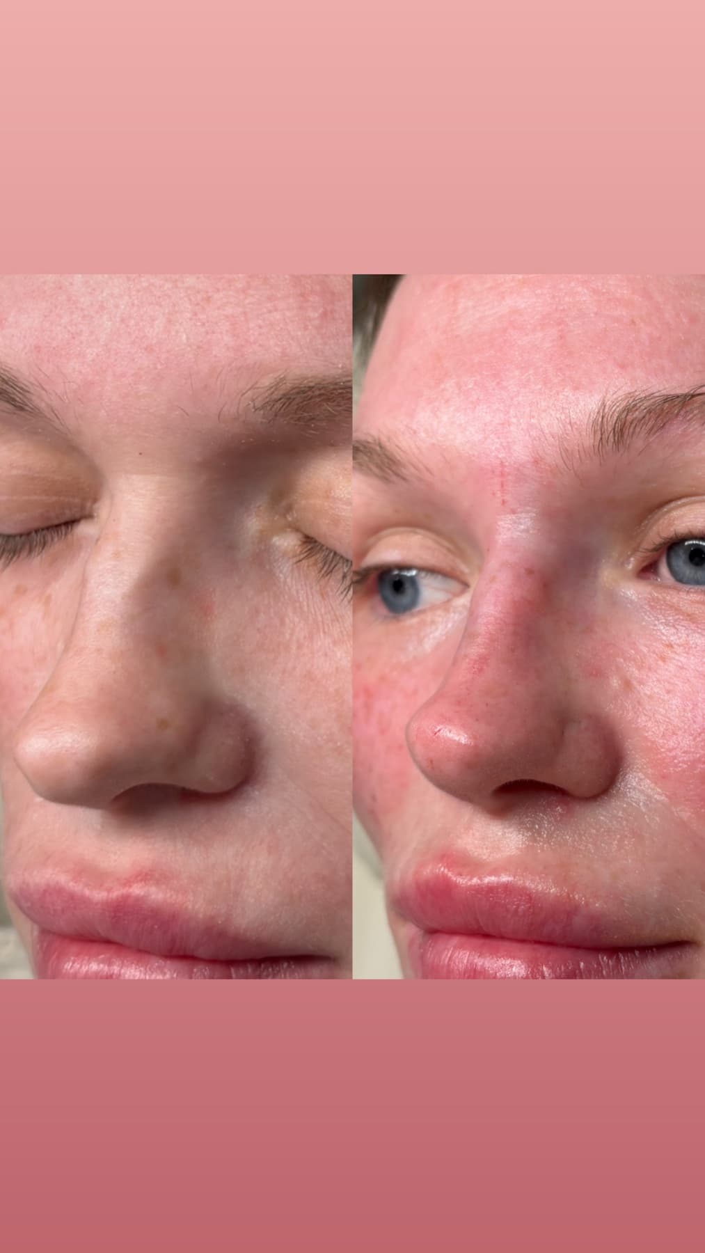 Non-Surgical Rhinoplasty before and after at Charis Aesthetics