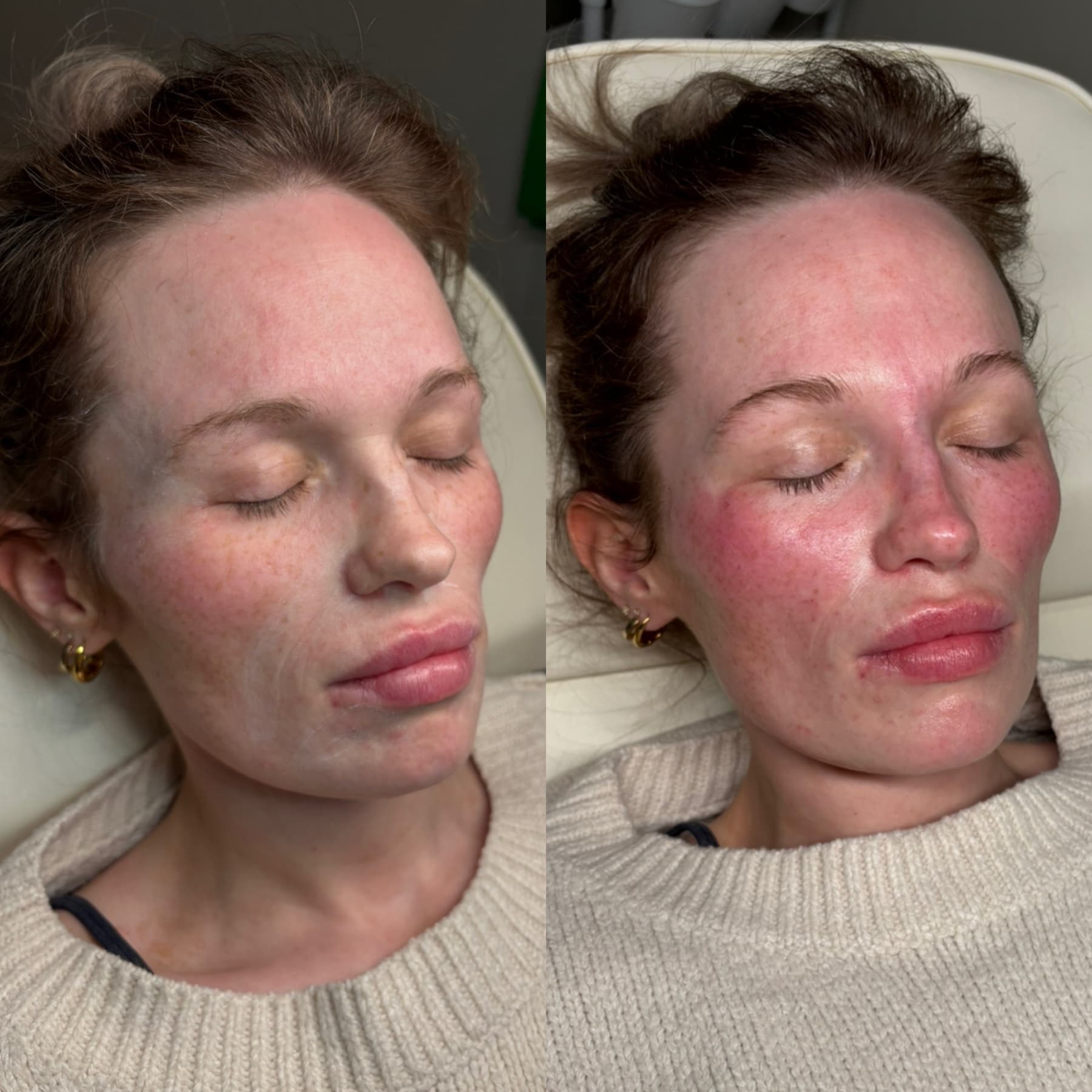 Facial Harmonisation before and after at Charis Aesthetics
