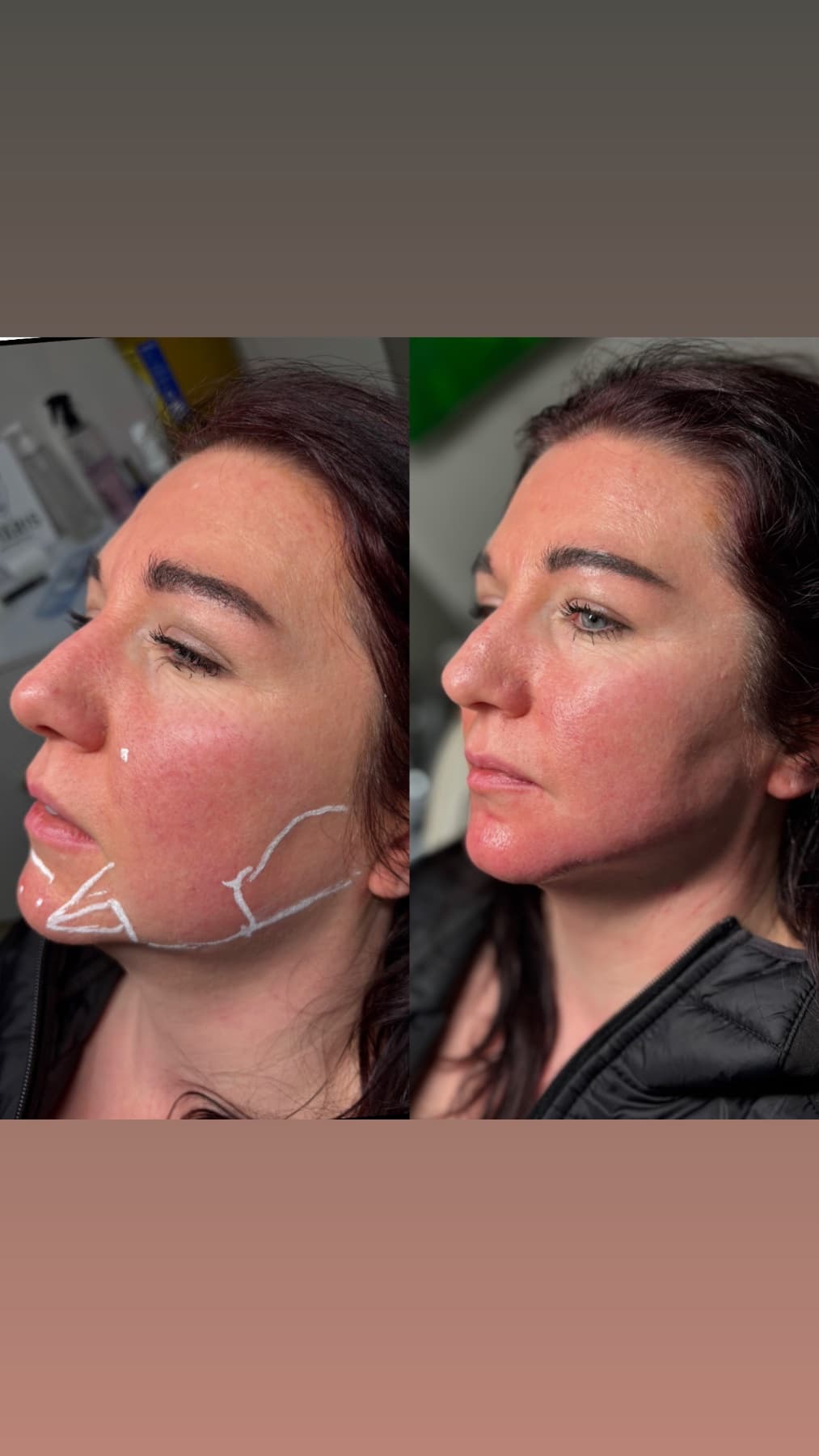 Jawline Filler before and after at Charis Aesthetics