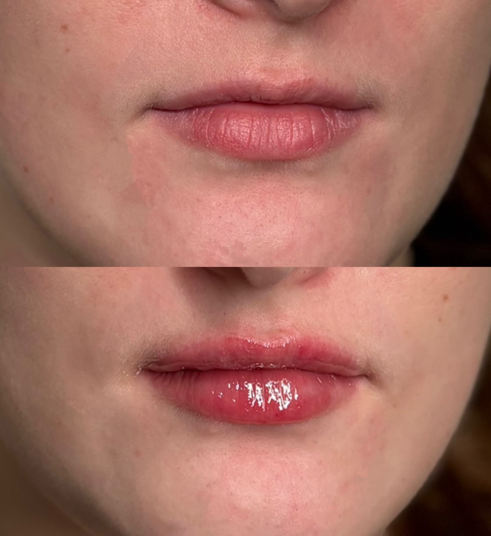 Signature Lips before and after at Charis Aesthetics