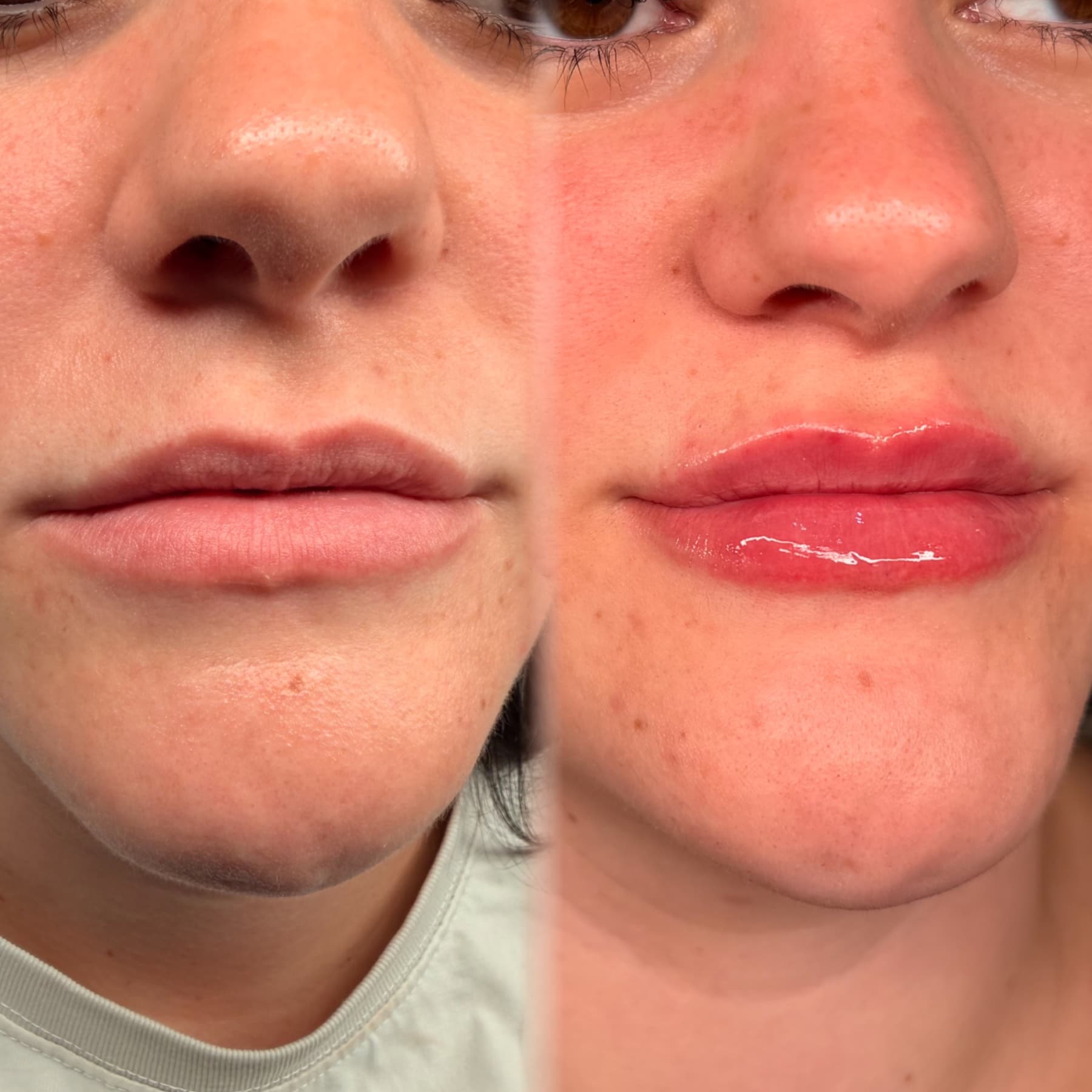 Signature Lips before and after — Over two sessions. Lips lifted, natural and minimal swelling and bruising!
