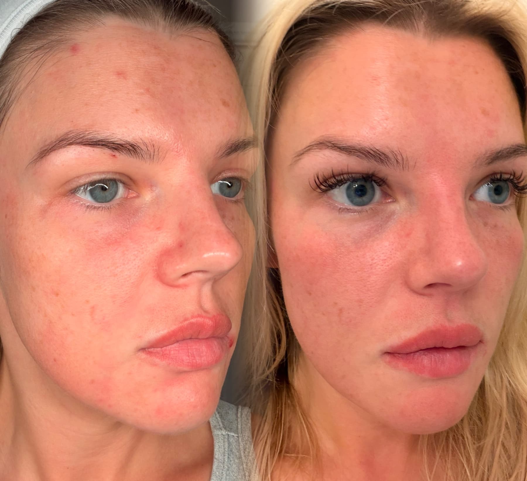 Teoxane BabyGLOW before and after at Charis Aesthetics
